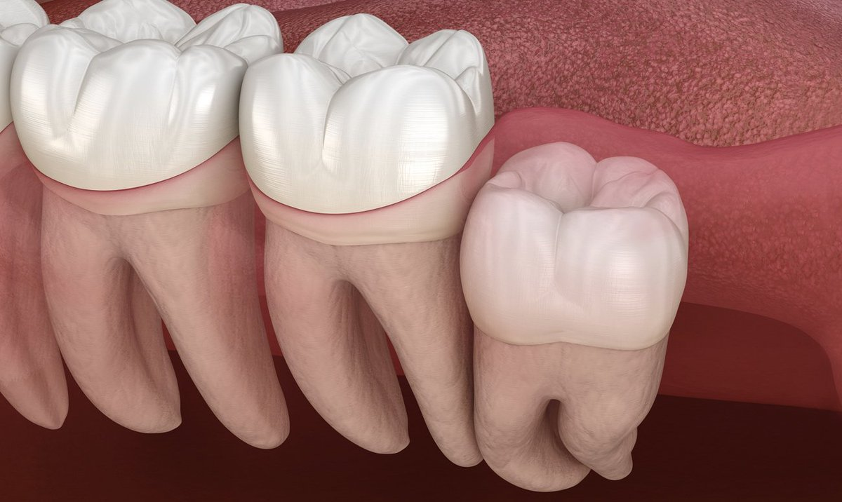 Лечение зуба 8