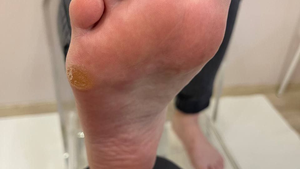 Неприятная мозоль