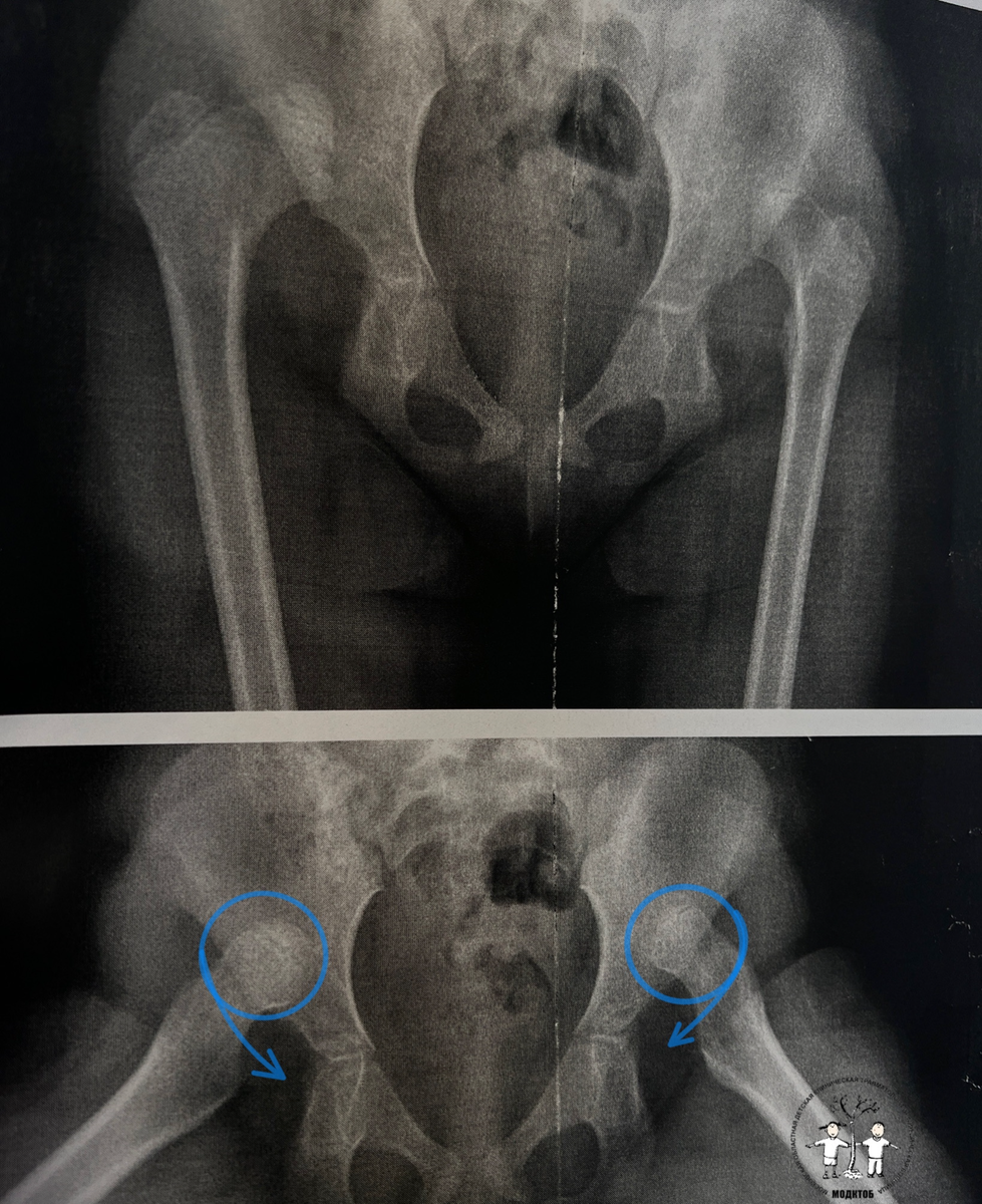 Двусторонний вывих бедер