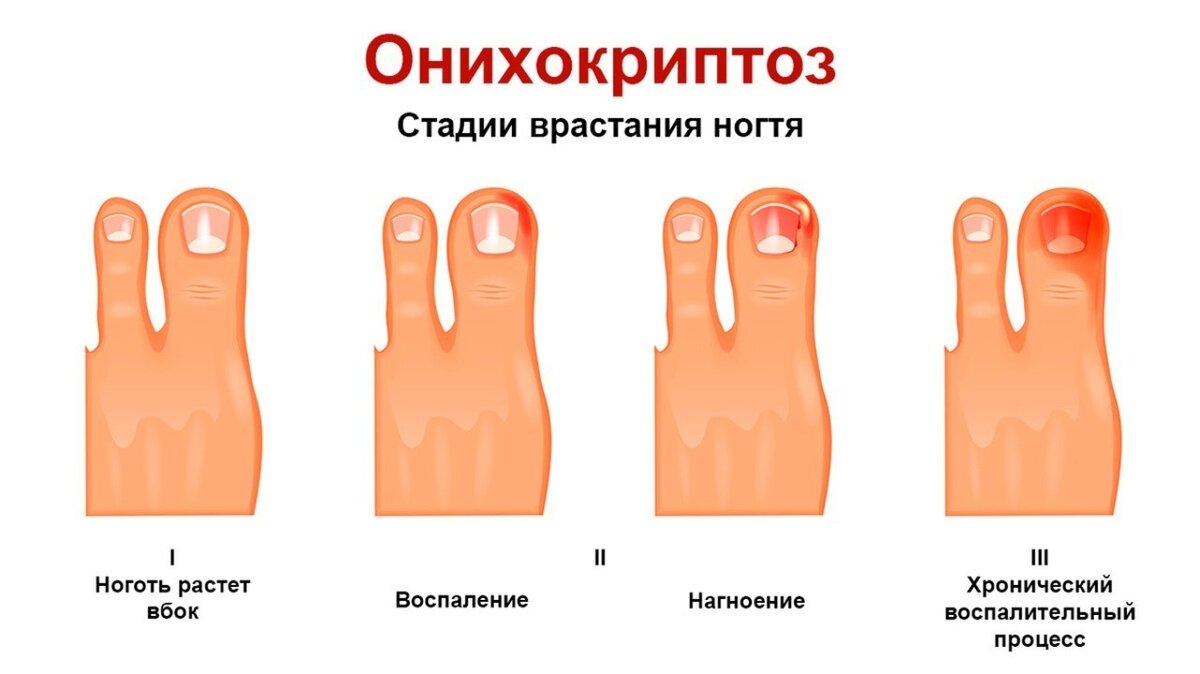 Стадии врастания ногтя
