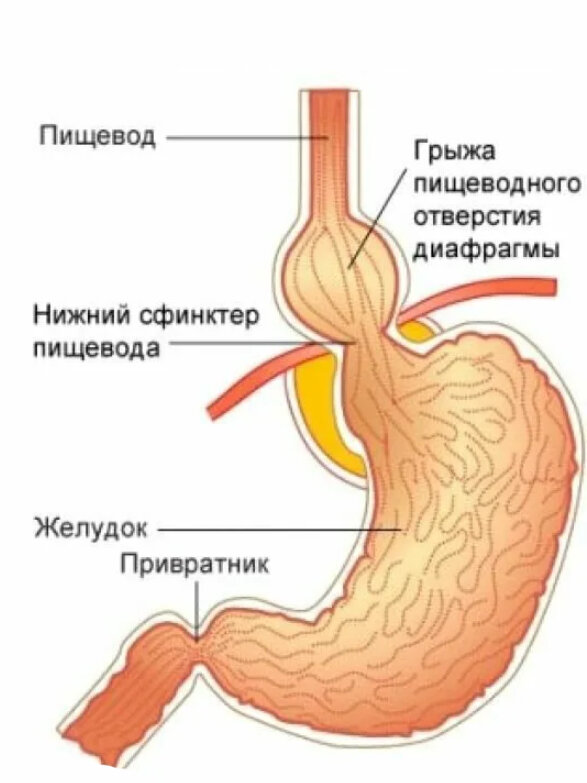 Хиатальная грыжа желудка