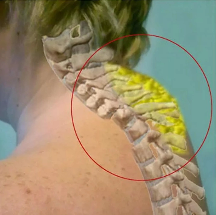 How to get rid of a hump on the neck, methods of removing the withers on the neck