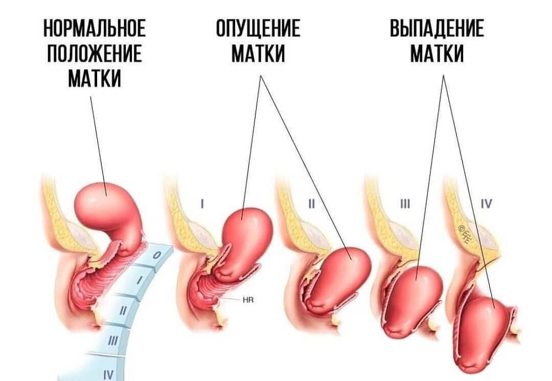 Если не хотите наблюдать такую картину, не делайте вакуум!