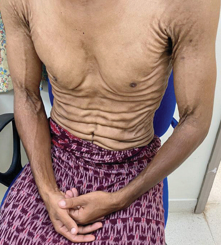   Manish Kumar and Abdul R. Saifudeen / The New England Journal of Medicine, 2023