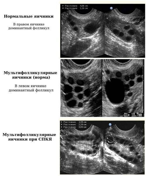 Эхо картина мультифолликулярных яичников