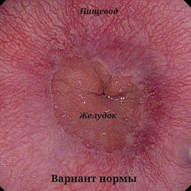 Эндоскопическая картина пищеводно-желудочного перехода в норме