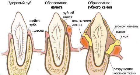 Поэтапное образование камня