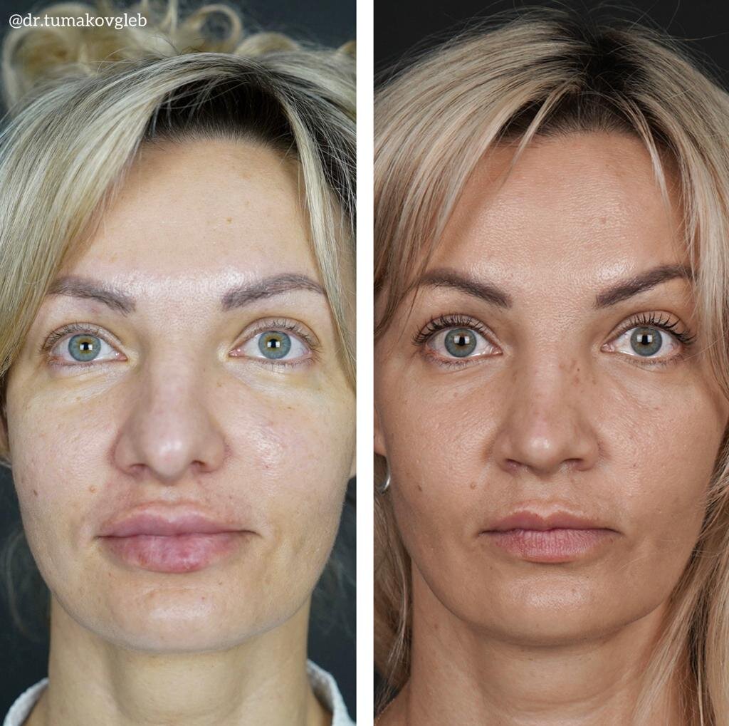 Результат риносептопластики спустя 1,5 месяца после операции.