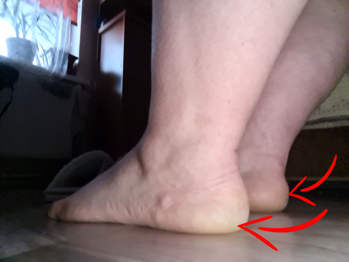 Лечение толстого ногтя на ноге