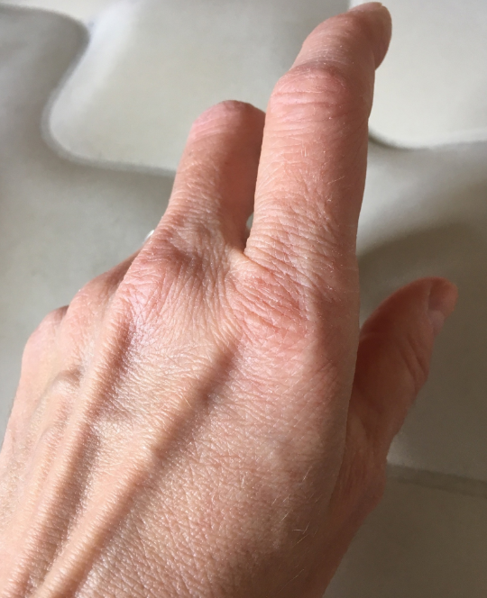 Сухие руки: причины и лечение - клиника Би Лучче, Новосибирск