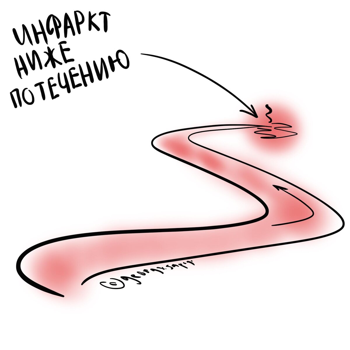 Как часто случается инфаркт при стентировании? | Для пациентов | Дзен