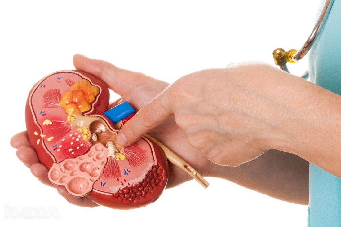 Dacă aveți urolitiază: cum puteți încerca să eliminați nisipul și pietrele de la rinichi