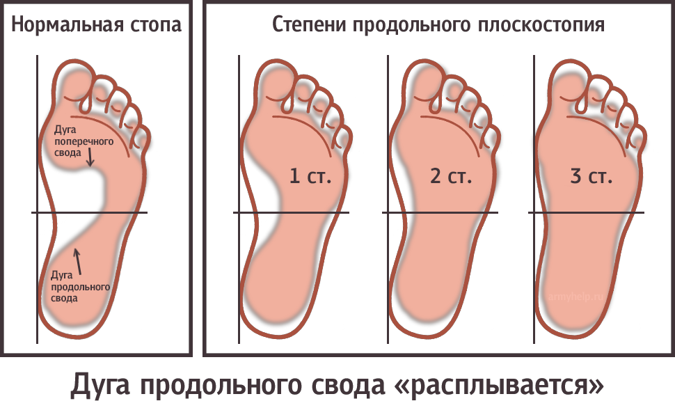 Продольное плоскостопие категория годности. Плоскостопие 3й степени градусы. Продольно-поперечное плоскостопие степени. Плоскостопие 2-3 степени.