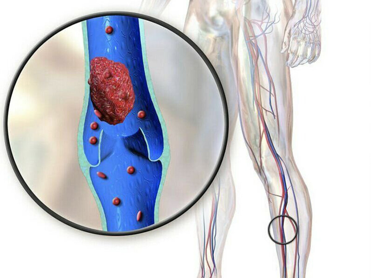 тромб в вене на ноге