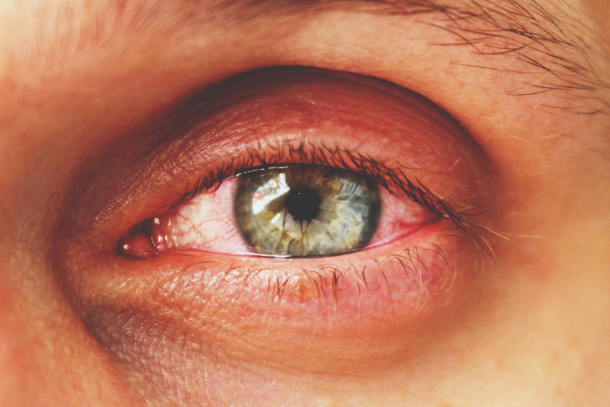 Слезотечение из глаз причины у взрослых. Хламидийный конъюнктивит-кератит.