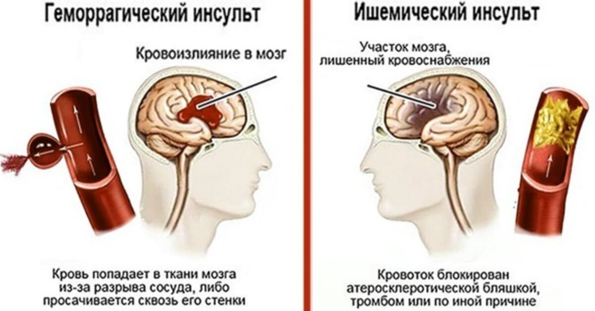 После геморрагического инсульта. Симптомы геморрагического и ишемического инсульта. Причины геморрагического инсульта головного мозга. ОНМК геморрагический инсульт симптомы. Ишемический инсульт Возраст больных.