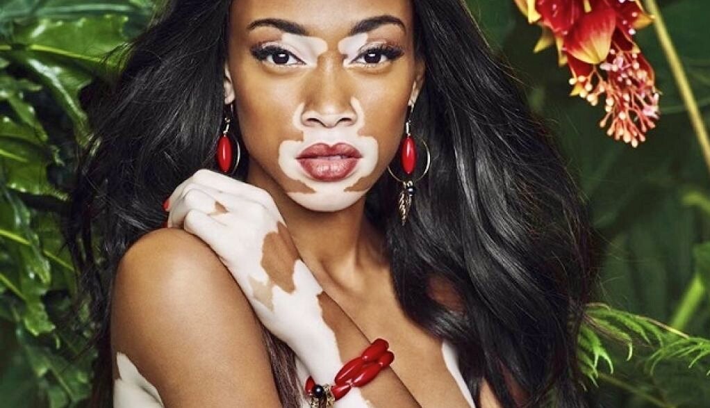 Шантель Браун-Янг Chantelle Brown-Young - девушка модель с редкой болезнью.