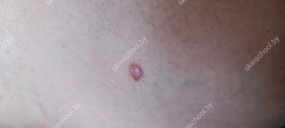 Дерматофибромы | Советы дерматолога|Sovetydermatologa | Дзен