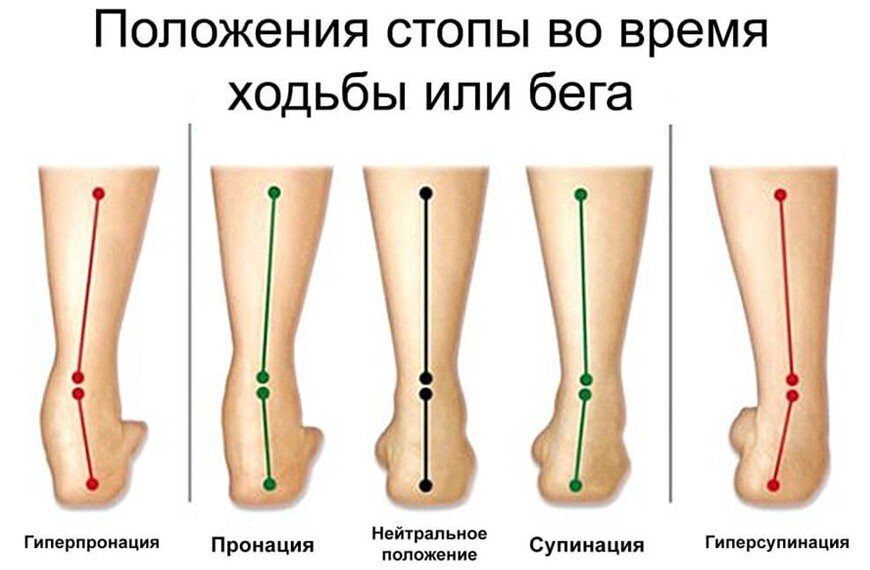 Во время ходьбы нога. Пронация и супинация стопы. Пронация стопы гиперпронация. Плоскостопие пронация стопы. Гиперпронация стопы плоскостопие.