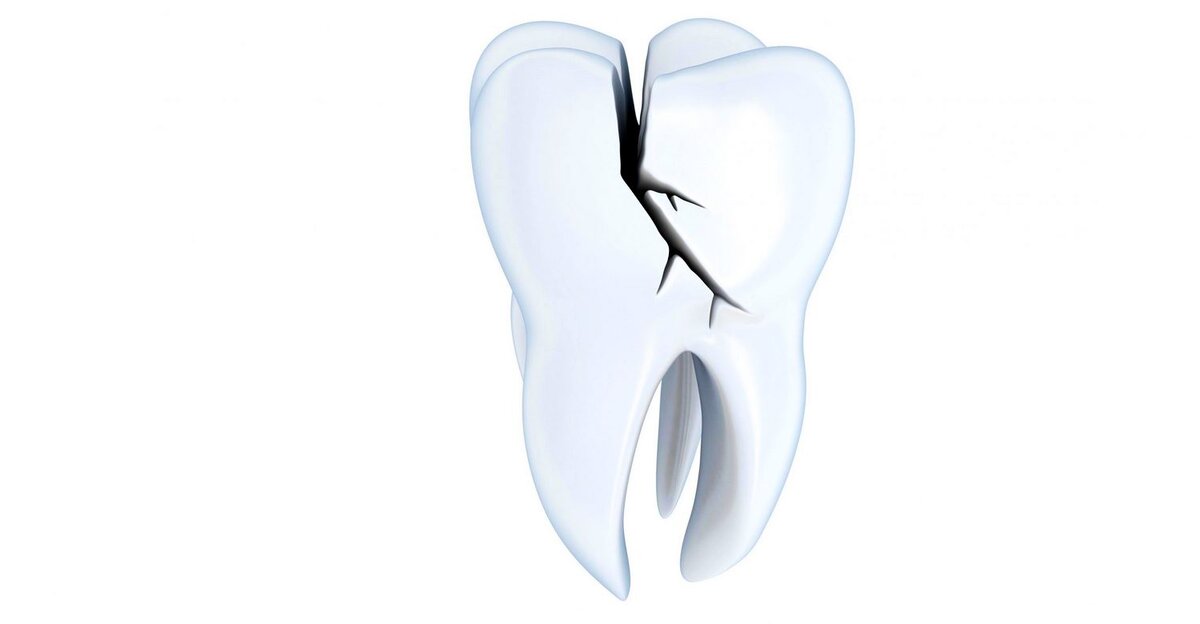 Причины появления внутри зуба трещины