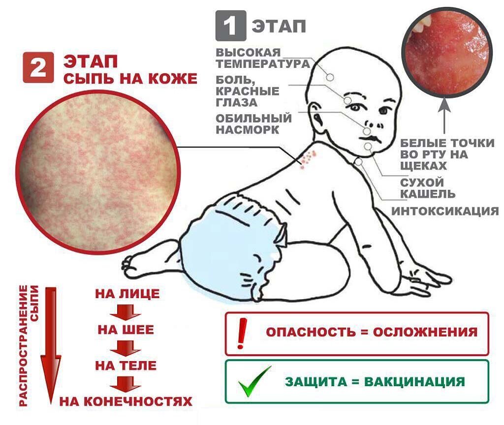 Корь. Из открытого источника Я.Картинки.