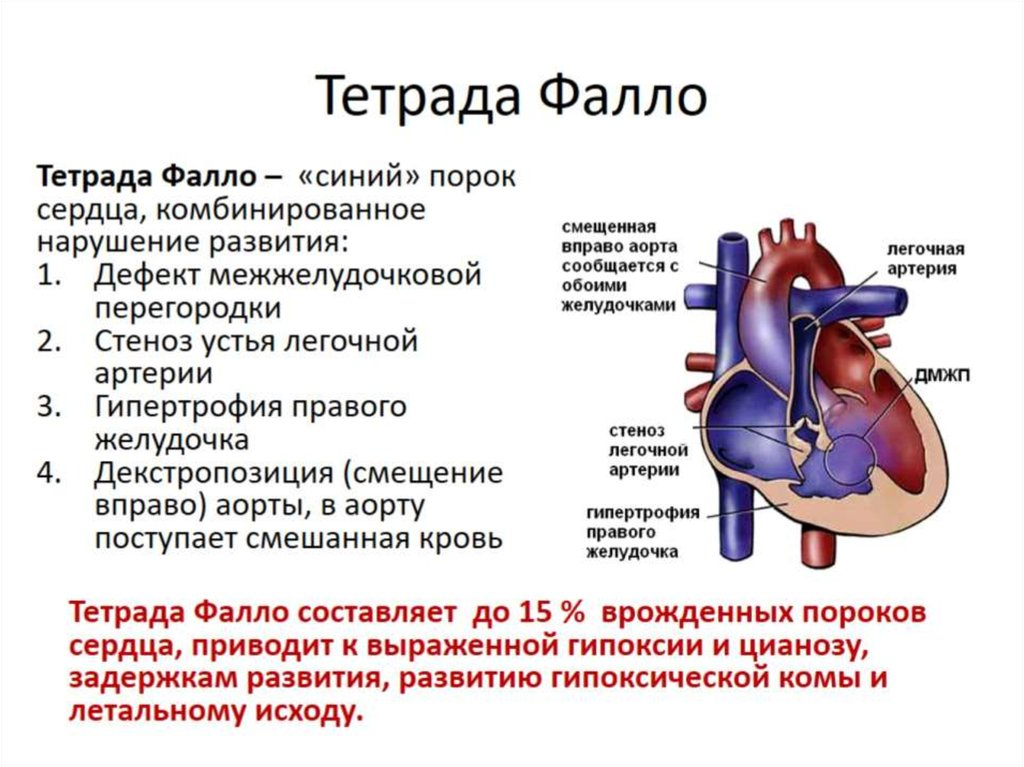 Пороки сердца впс. Врожденный порок сердца Тетрада Фалло у детей. Тетрада Фалло это врожденный порок сердца. Клинические симптомы тетрады Фалло. Врожденные пороки сердца гемодинамика Тетрада Фалло.