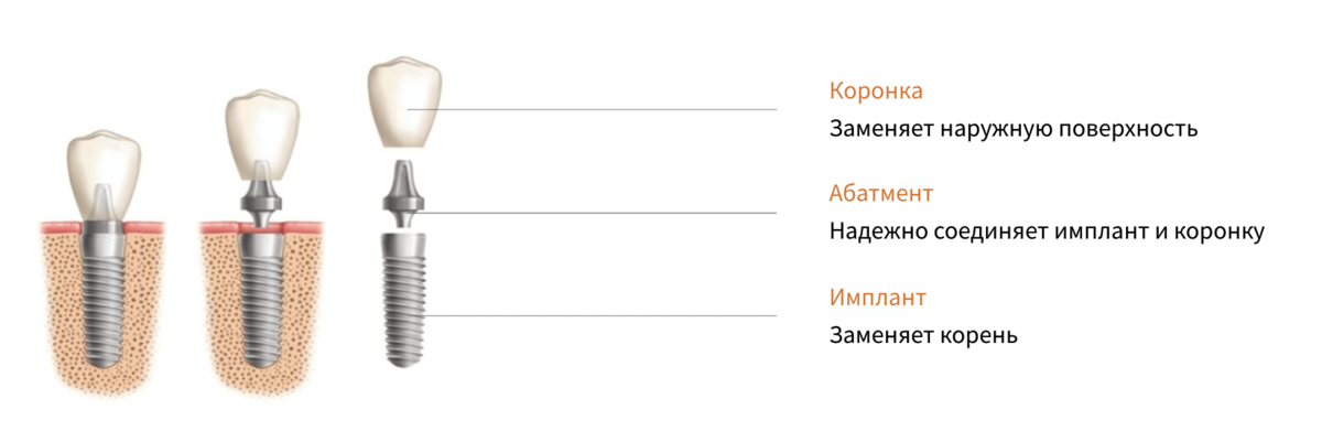 Схема восстановления зуба. Коронку или протез могут фиксировать на зуб без импланта. Фото Доктора Федорова.