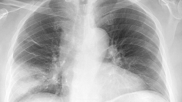 Фото © Wikimedia Commons / Mikael Häggström