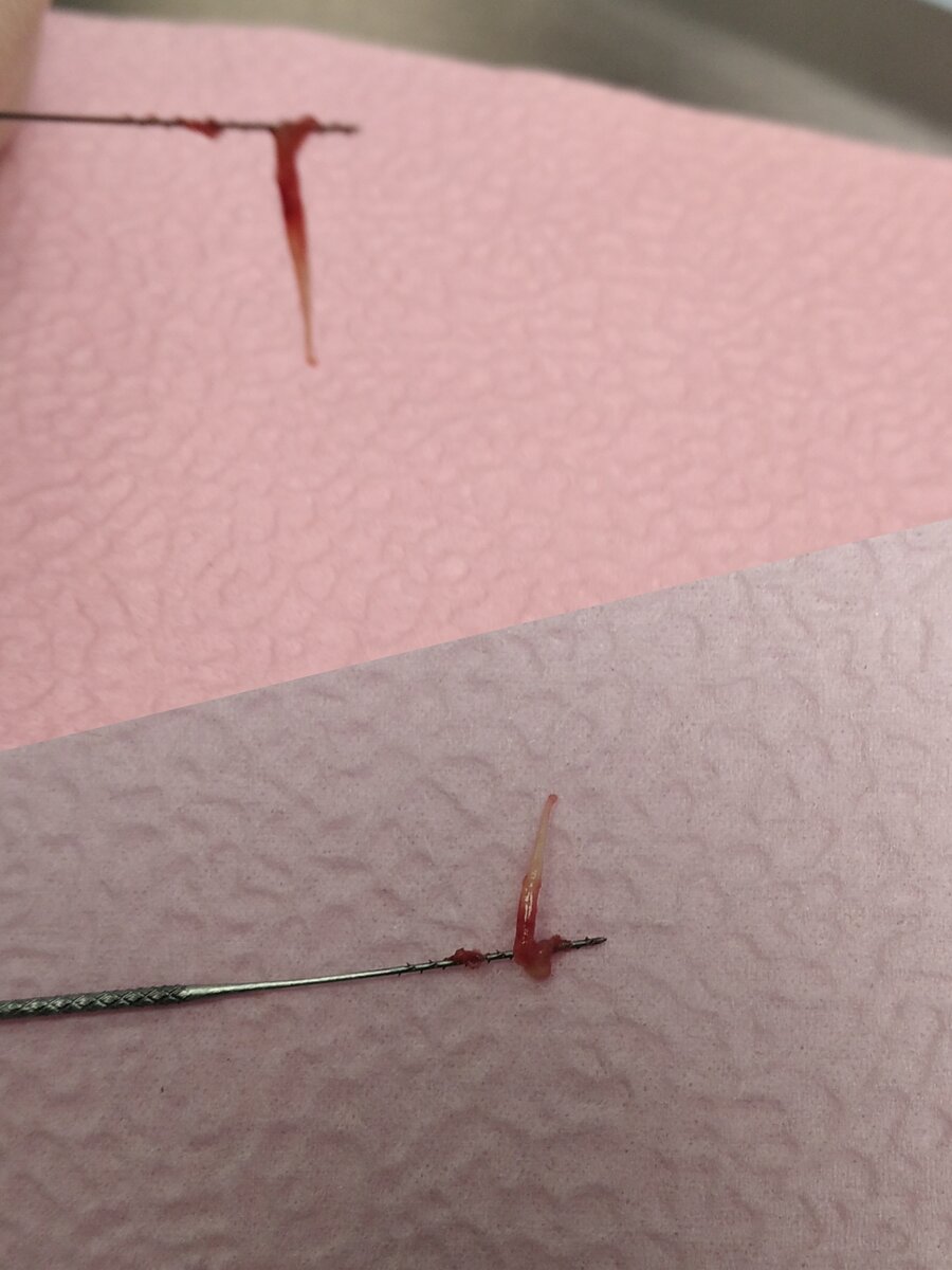 К тому же особенности иннервации наших зубов, то есть сообщения их с нервами в организме, способствуют тому, что боль становится невыносимой и распространяется на многие области - височную, шейную, другую челюсть. В период ремиссии боль становится хронической и не такой невыносимой, но это лишь на некоторое время - снова до следующего обострения. Это важно понимать, потому что прекращение боли не значит выздоровление.

Поэтому, если Вы ощутили резкую сильную боль и боль от принятия горячей, холодной пищи, а также если у вас разрушен зуб и нет ещё никаких болевых ощущений, обратитесь к врачу-стоматологу.  Вылечить пульпит дома невозможно и если Вам удалось пережить страшные зубные боли и Вам кажется что всё, больше нечего не болит, увы нет, это значит что нерв умер и скоро там начнётся периодонтит. 