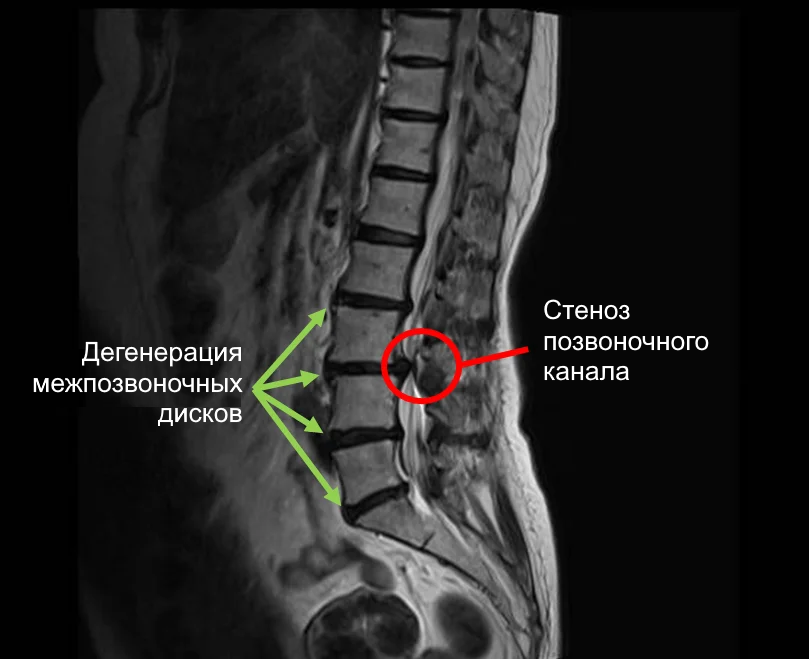 Расширение спинного канала. Стеноз позвоночного канала. Стеноз позвоночного канала лечение. Упражнения при стенозе позвоночного канала. Классификация стенозов позвоночного канала по Шизас.