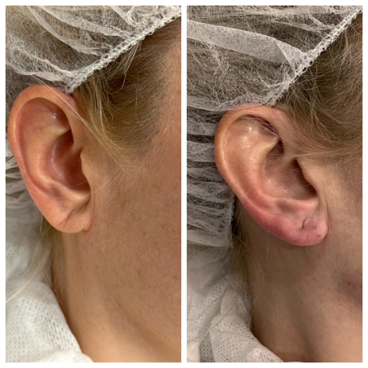 Результаты до и после контурной пластики мочек ушей 