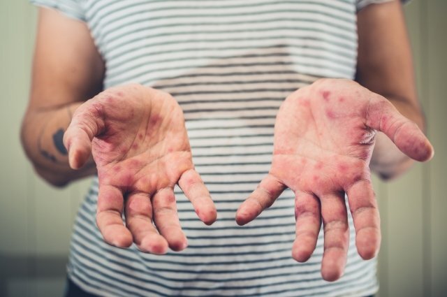    Могут ли заболеть корью те, кто прививался в детстве?