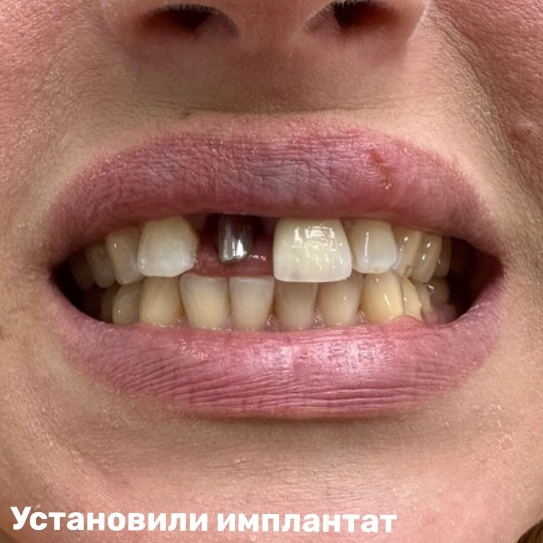 Установили имплантат сразу после удаления корня и восстановления передней стенки костным блоком