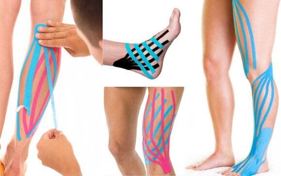 Кинезиотейпирование при варикозе