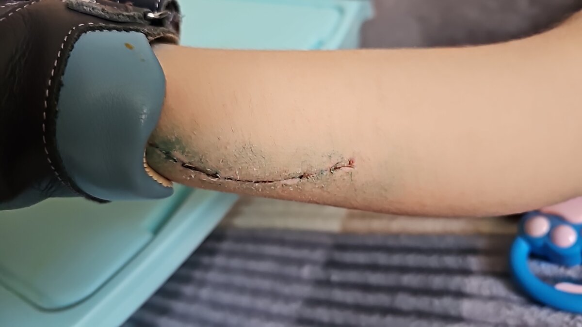 Сегодня наконец-то мы сняли гипс !