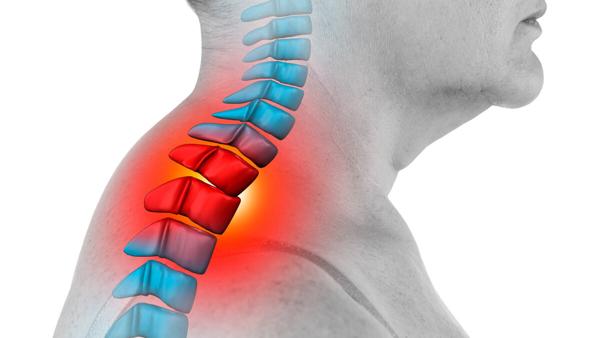 Шейный остеохондроз вдовий горбик