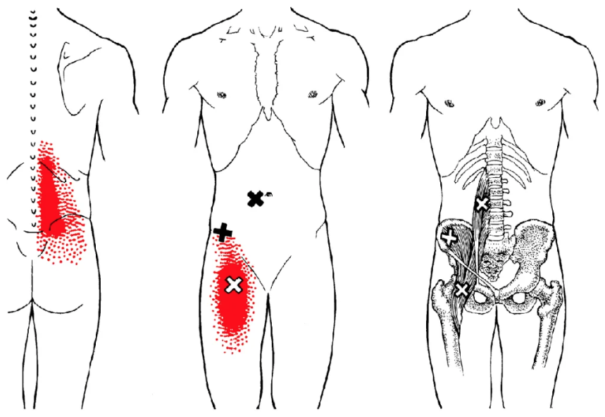 Поясничная грыжа боль в бедре. Триггерные точки мышц бедра боль. Подвздошно-поясничная мышца триггерные точки. Миофасциальный синдром подвздошно-поясничной мышцы. Триггерные точки в мышцах спины.
