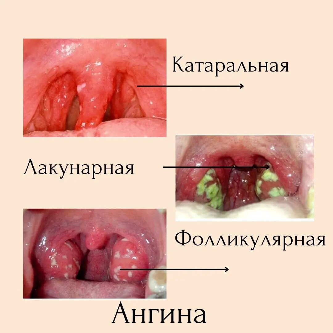 может быть ангина после минета фото 90