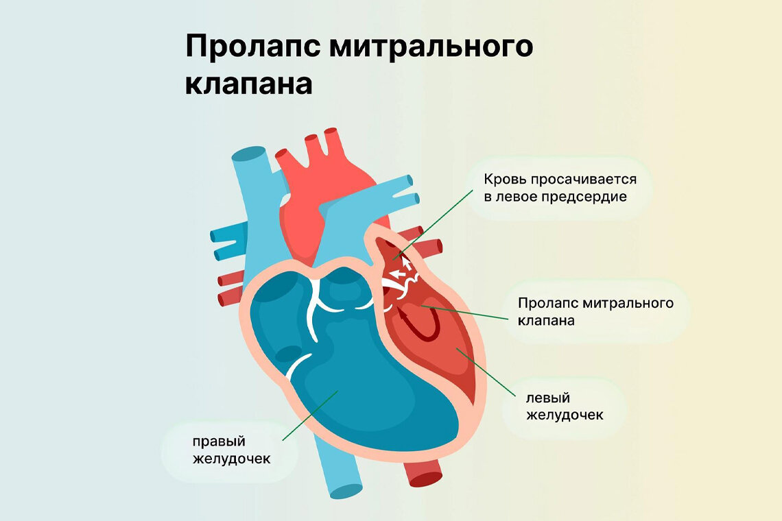 Пролапс митрального клапана (ПМК) – причины, симптомы и лечение.