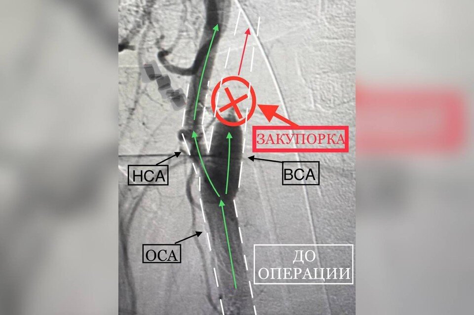     Закупорка в сонной артерии не позволяла крови поступать в головной мозг Фото: t.me/gorbolnica1nvrsk