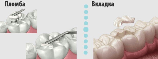 Что лучше поставить на зуб: пломбу или вкладку? | Стоматология ROOTT | Дзен