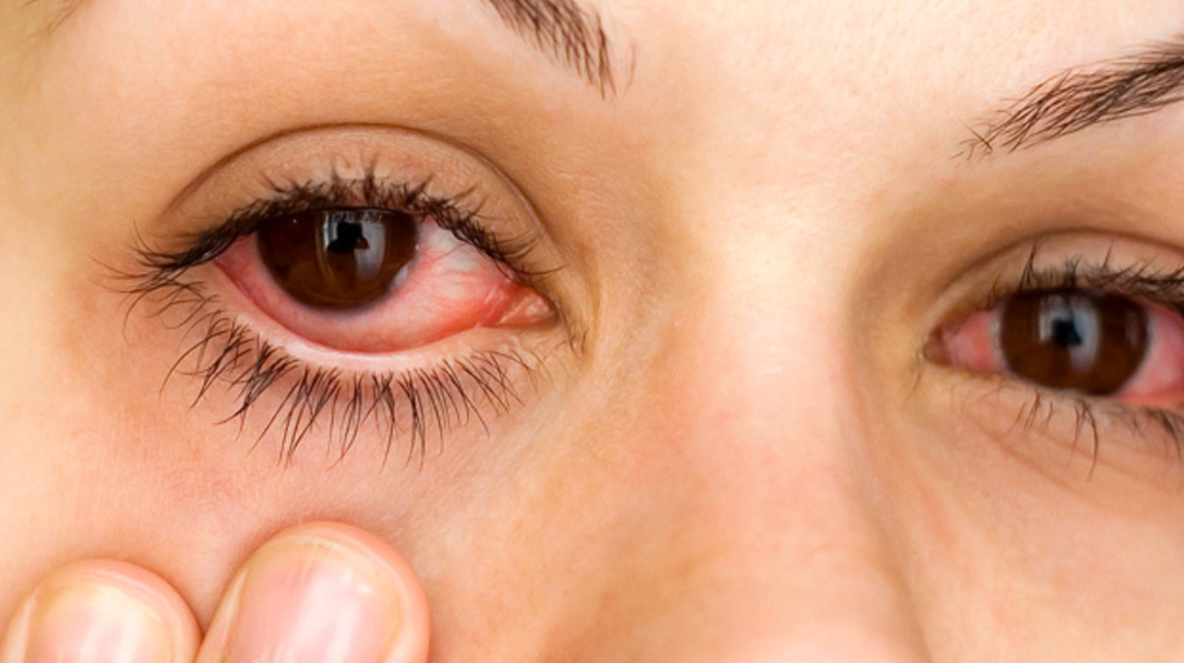 Слезотечение из глаз причины у взрослых. Покраснение глаз и слезотечение. Воспаление покраснение глаза.