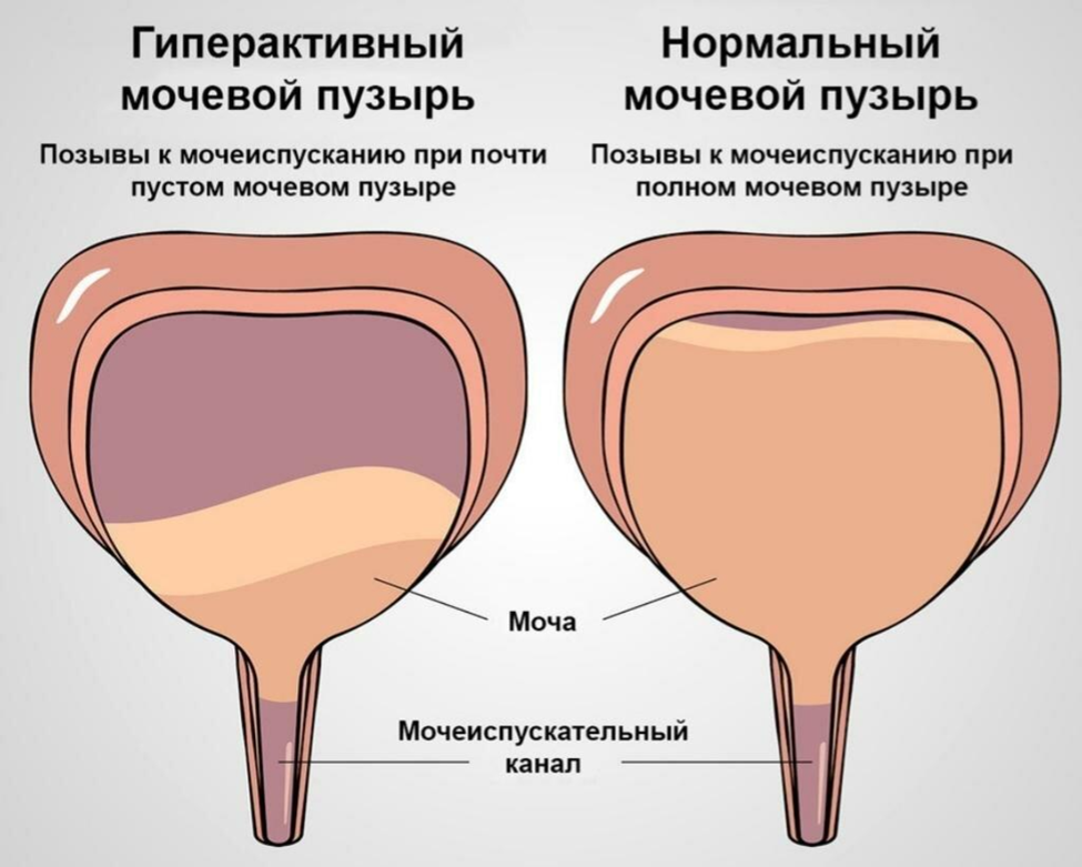 Подтеки мочи у мужчин. Гипо активный мочевой пузырь. Гиперактивный мочевой пузырь. Гипоактивый мочепвой пузырь. Нейрогенный гиперактивный мочевой пузырь.