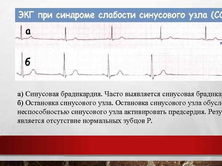 Синдром слабости синусового узла карта вызова