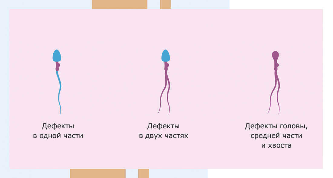 Аномалии сперматозоидов и влияние на мужскую репродуктивную систему
