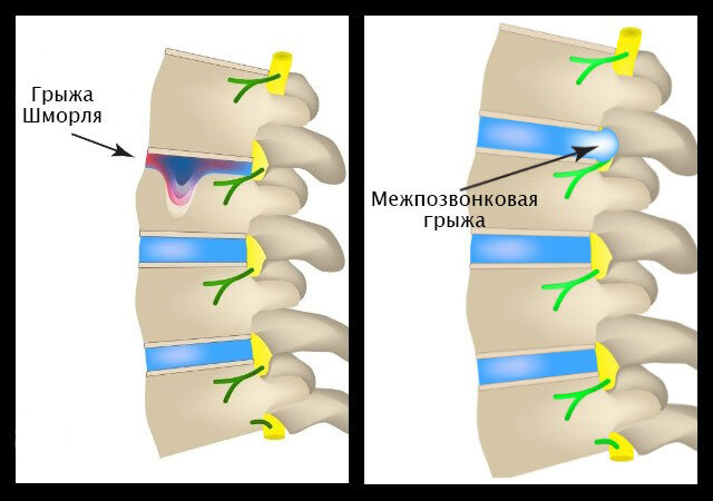 Грыжа Шморля: лечение, причины и симптомы | Клиника Temed
