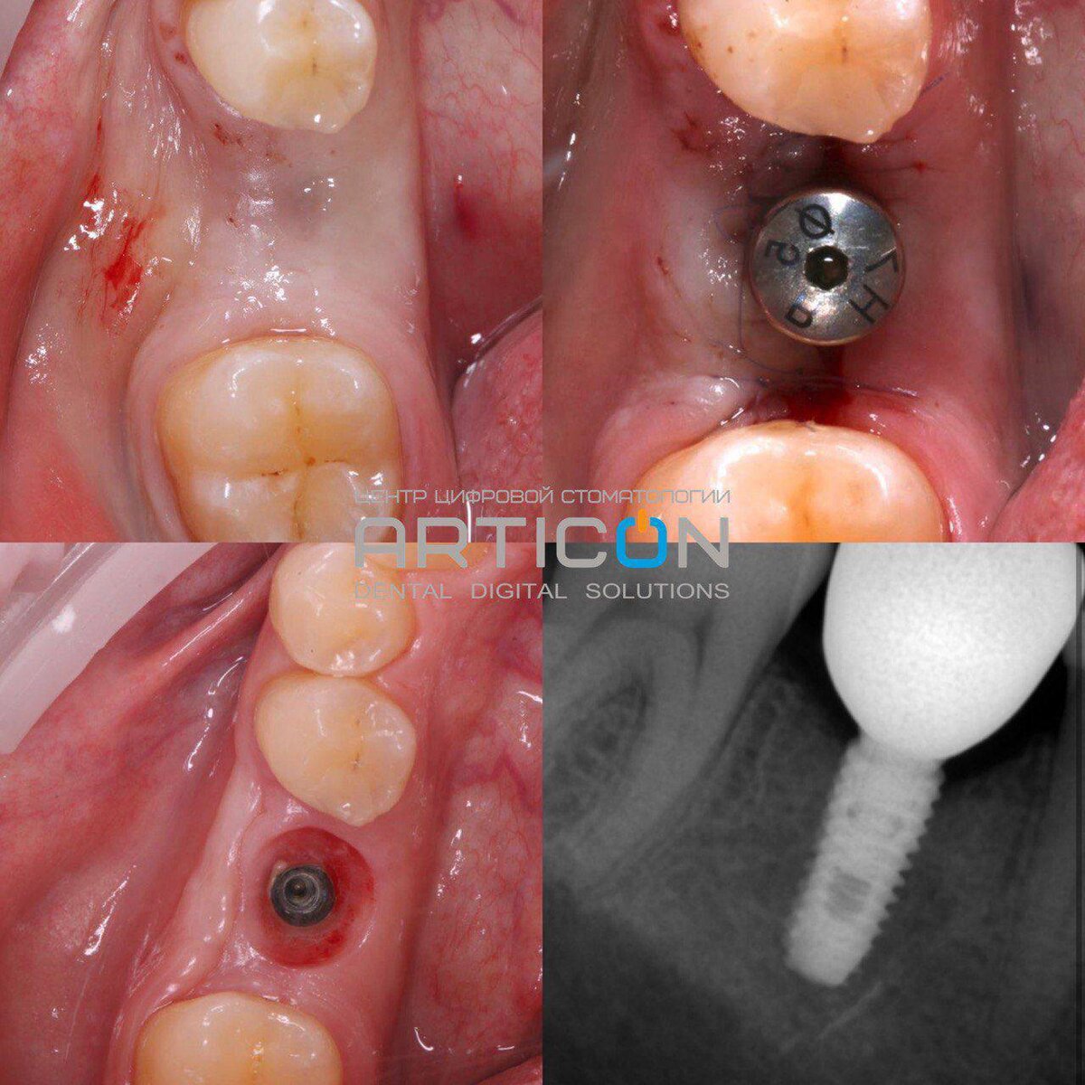Вся правда об имплантации зубов. Что вас ждет? | ARTICON цифровая  стоматология в Москве | Дзен