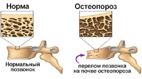 Симптомы остеопороза у женщин после 50 лет