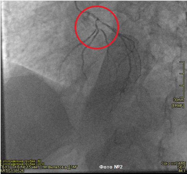 Экстренное коронарное шунтирование при остром инфаркте миокарда | ГКБ ...