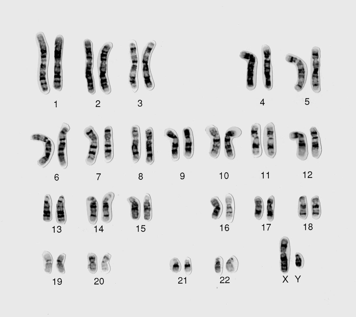 23 хромосомы у человека в клетках. Нормальный кариотип человека 46 хромосом. Мужской кариотип 46 XY. 46,XY нормальный мужской кариотип. Хромосомная карта кариотип.